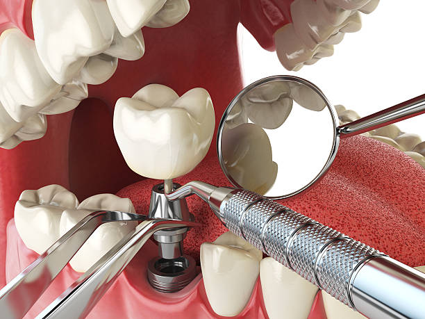 Best Broken or Cracked Tooth Emergency Dentist in Huntsville, MO