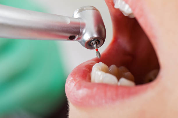 Best Emergency Dental Extractions in Huntsville, MO
